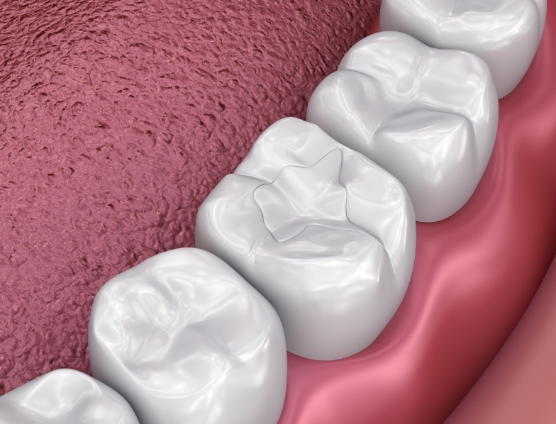 Animated row of teeth with dental sealants