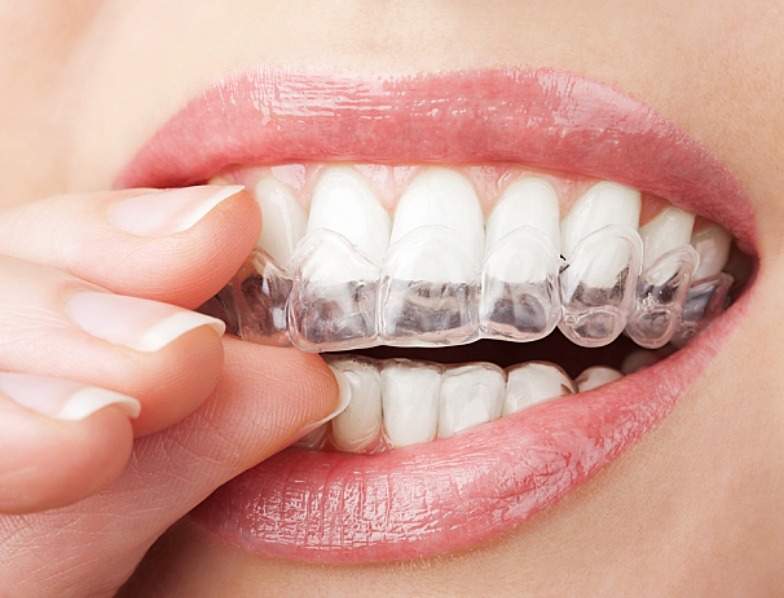 Close up of person placing whitening tray in their mouth