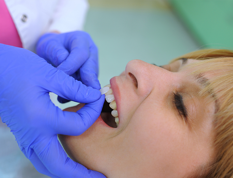 Dentist placing veneer over a patient's tooth