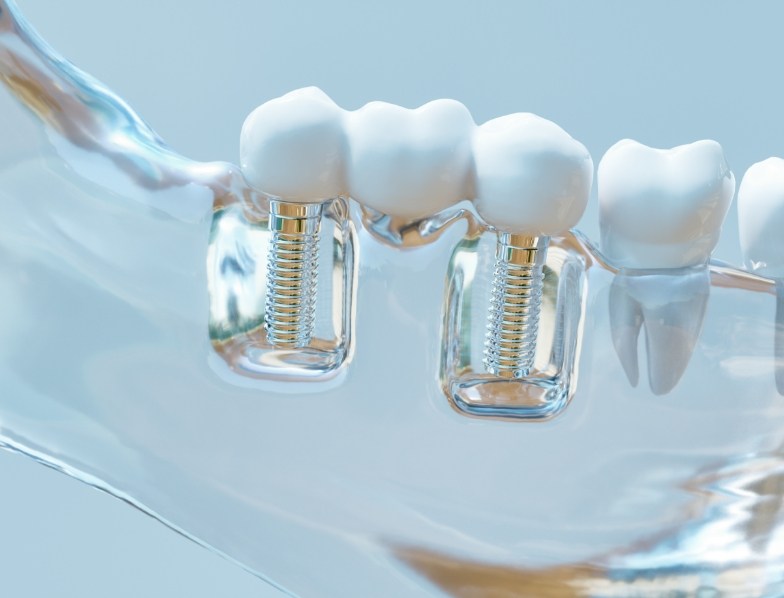 Model of mouth with two dental implants in Atlanta