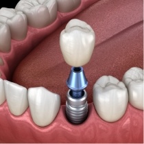 Animated dental implant with dental crown