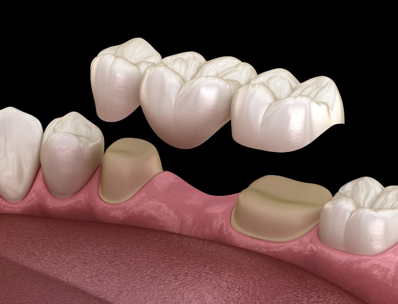 Animated dental bridge being placed in the mouth