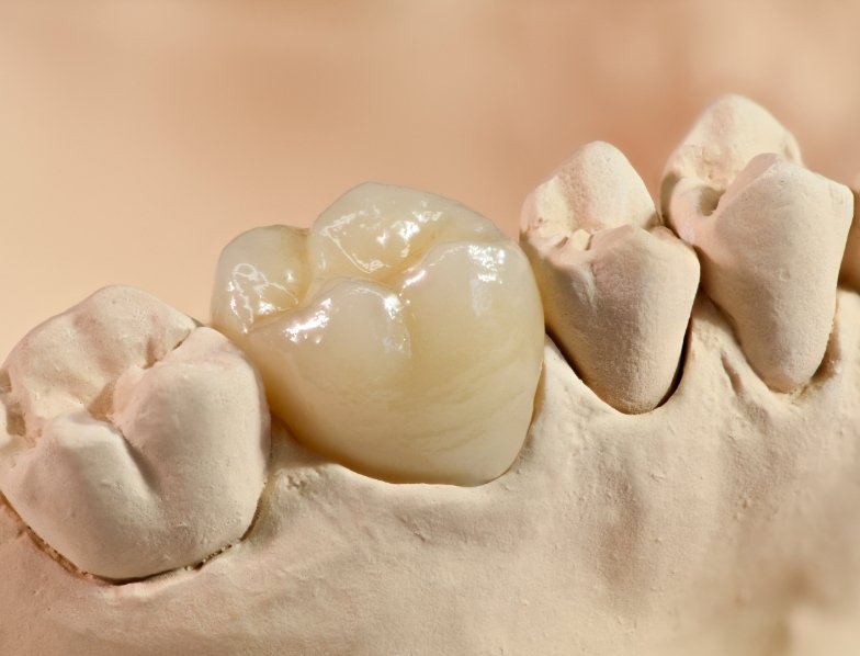 Dental crown in a model of the mouth