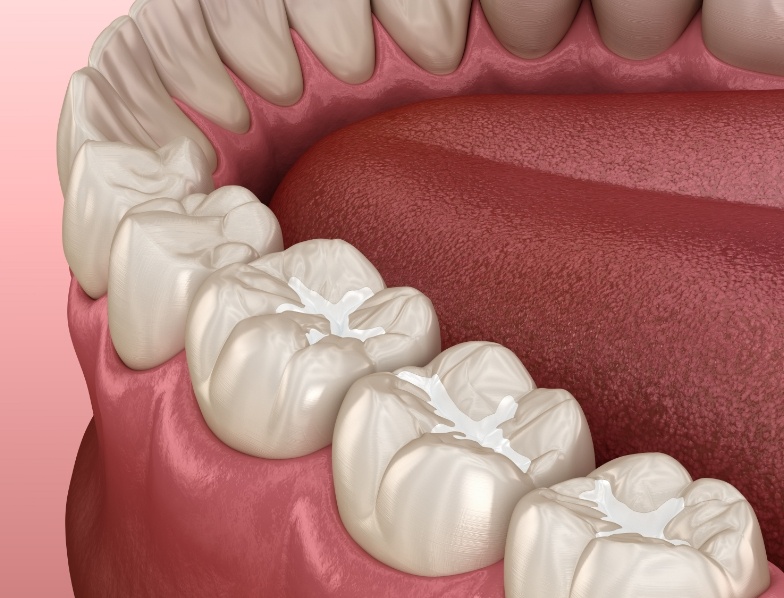 Animated row of teeth with white fillings