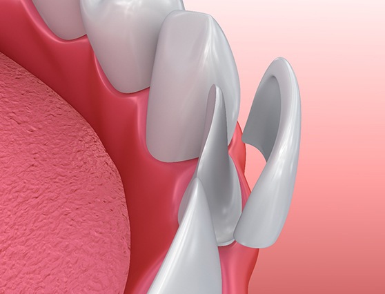 Illustration of veneer in Atlanta, GA being placed on tooth